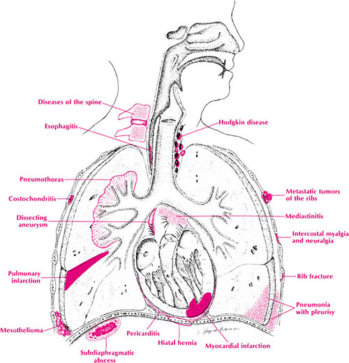 causes of chest pain