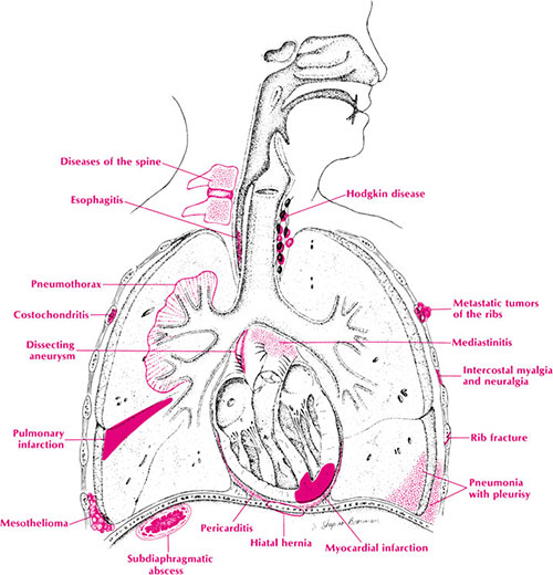 Costochondritis+pictures