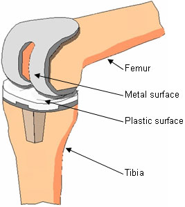 knee-replacement