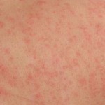 typhus rash
