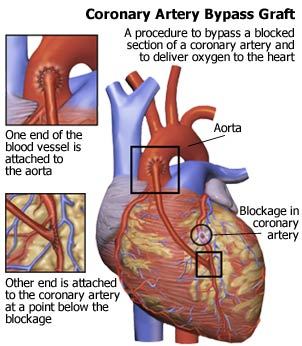 BypassGraft