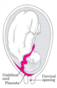 placenta previa