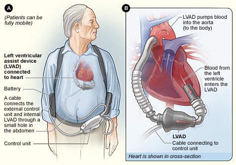 dick cheney heart pump. Dick Cheney#39;s Heart Gets