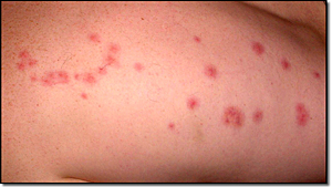 What does the rash of bedbugs look like and how do you treat it?