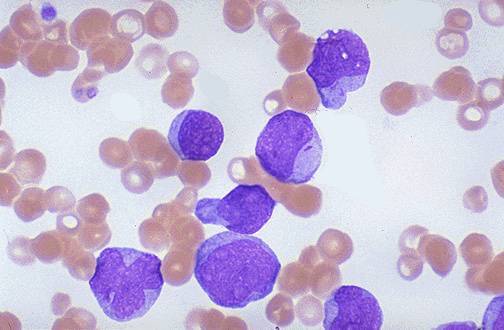 Symptoms of leukemia include: