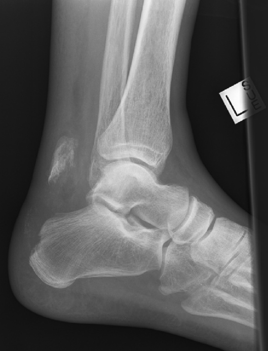 Stress+fracture+foot+mri