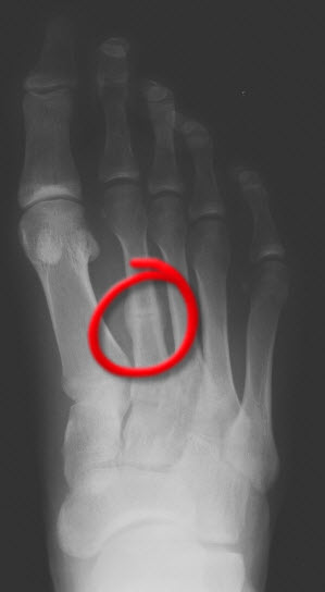 Pain in foot after stress fracture - foot pain symptoms discussed.