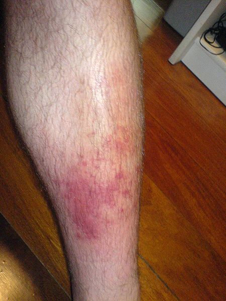 Cellulitis3