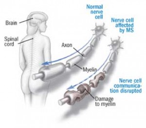 multiple-sclerosis