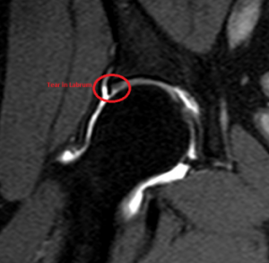 Labrum-tear-350x342