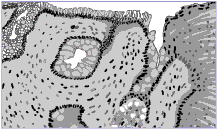 Barrett's Esophagus