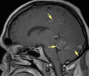 leptomeningeal_carcinomatosis