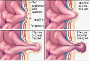 stages of hernia