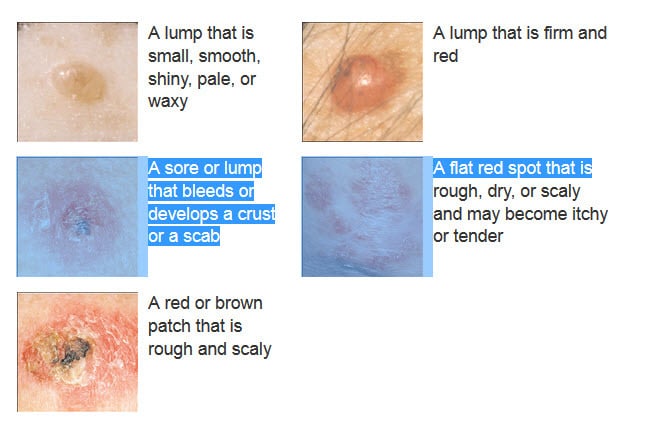 Picture of Basal Cell Carcinoma on the Nose - WebMD