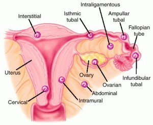 ectopic pregnancy