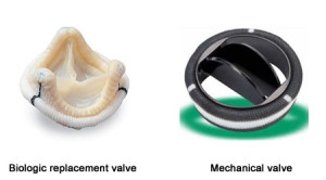 valves