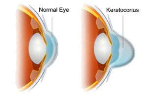keratoconus