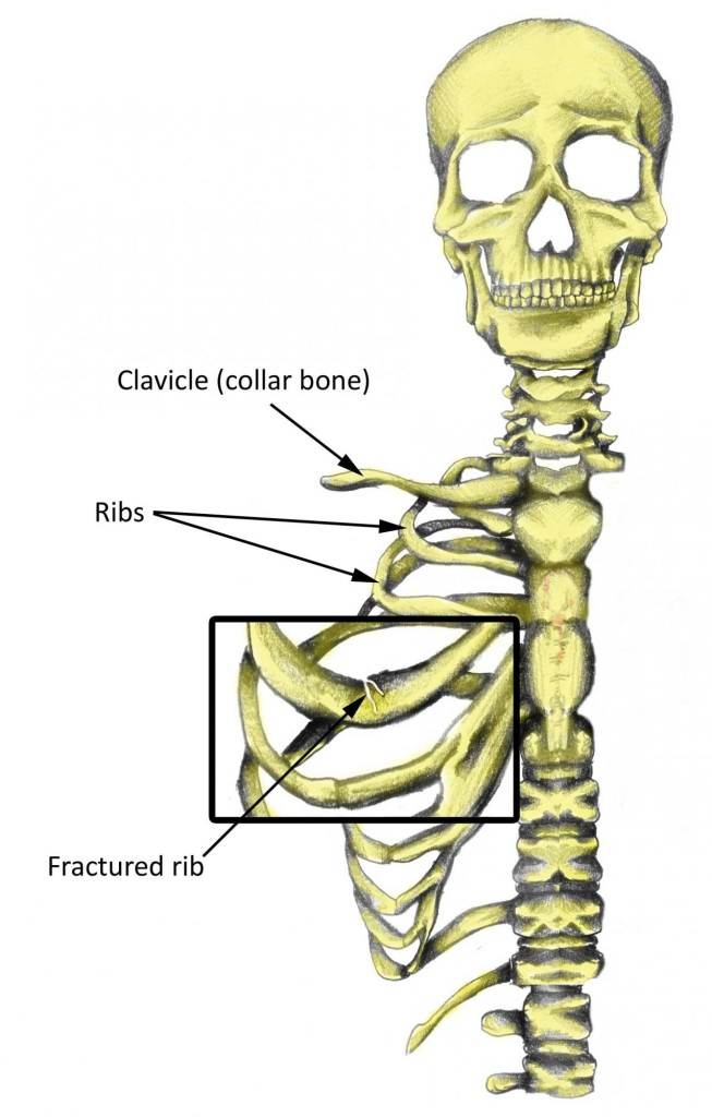rib_fracture-labelled