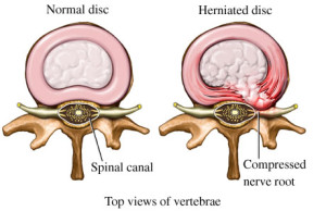 Herniated-Disc2