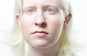 albinism