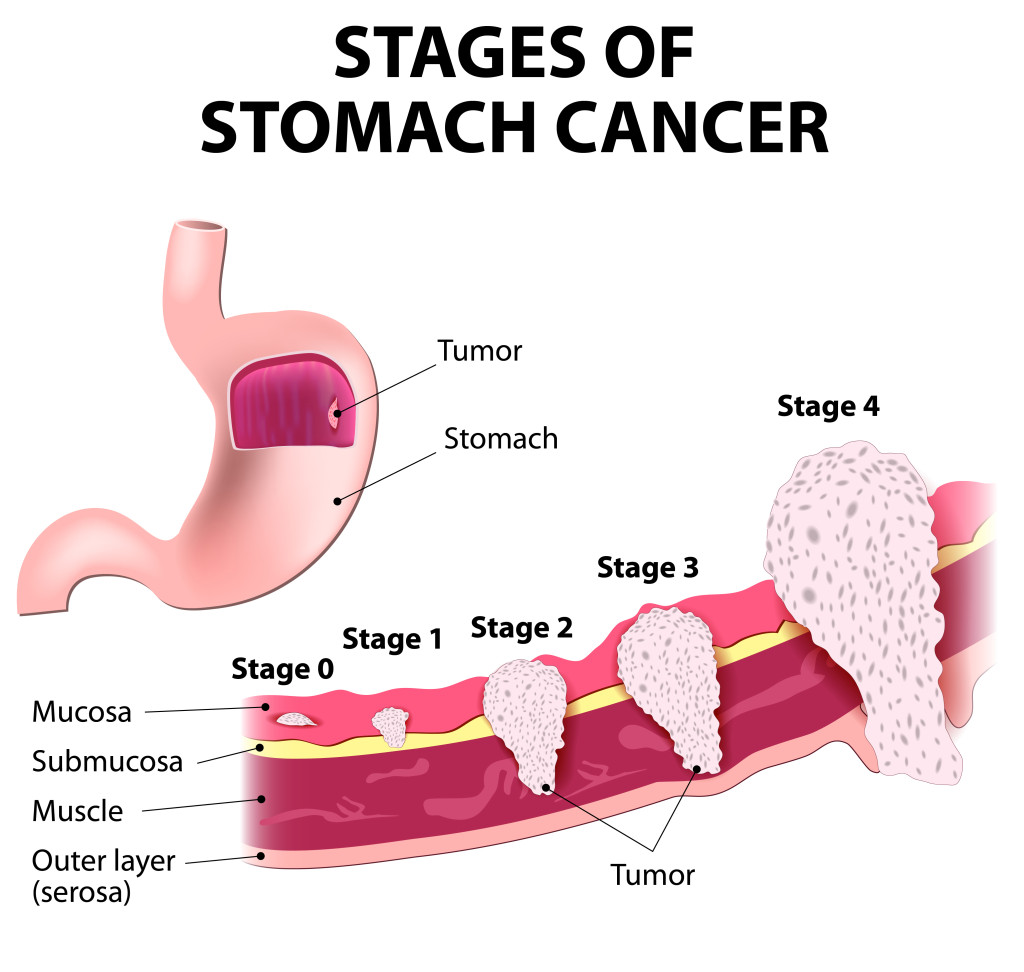 The clinical stages of stomach cancer. Classification of Malignant Tumours