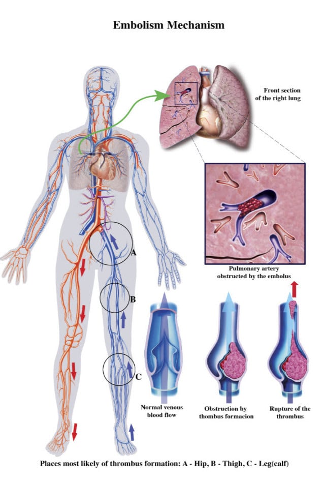 pulm embolism snagged