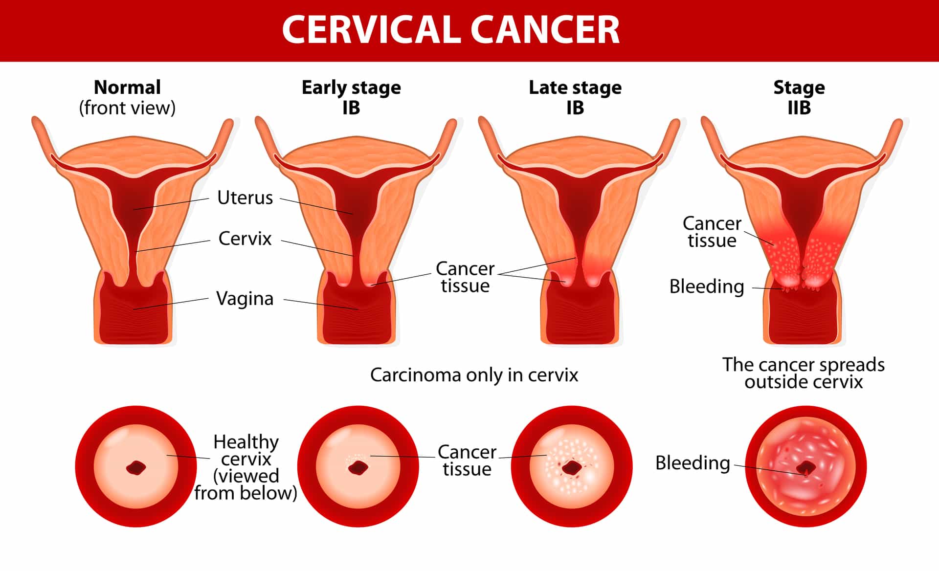 Cervical Cancer. Carcinoma of Cervix. Malignant neoplasm arising from cells in the cervix uteri. Vaginal bleeding. Vector diagram