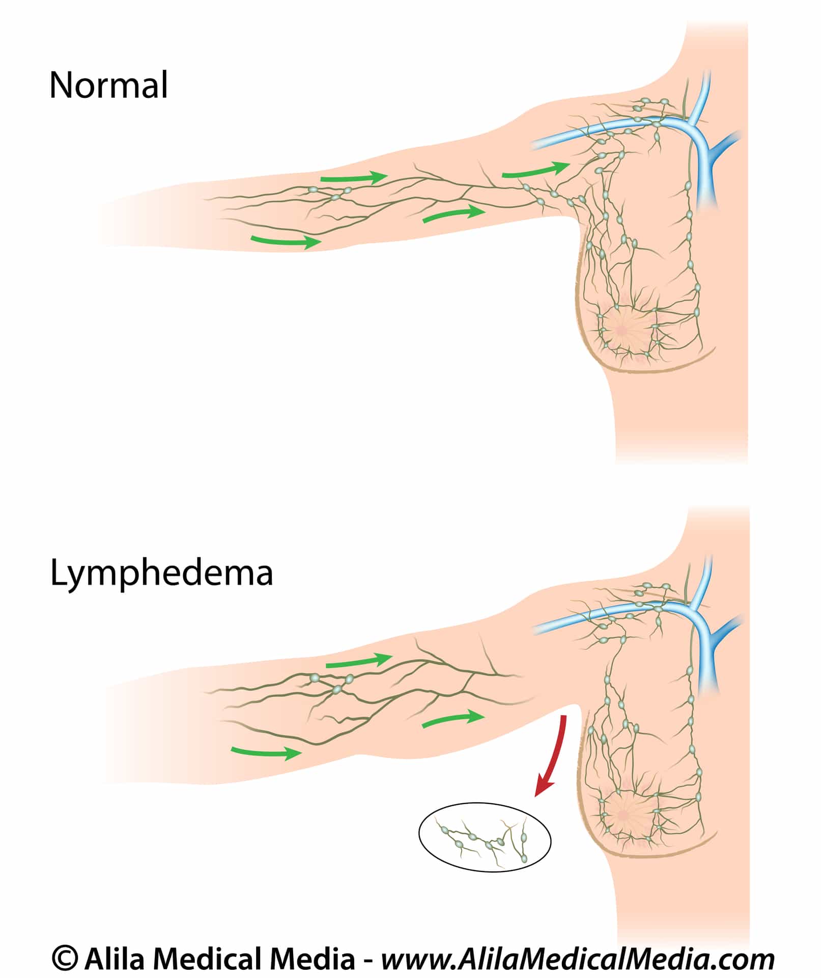 lymphedema (2)