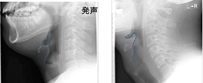 Normal xray vs. patient with epiglottitis