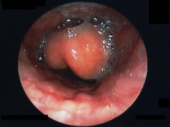 Epiglottitis_endoscopy