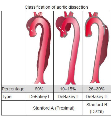 stanford-a-type-aortic-dissection