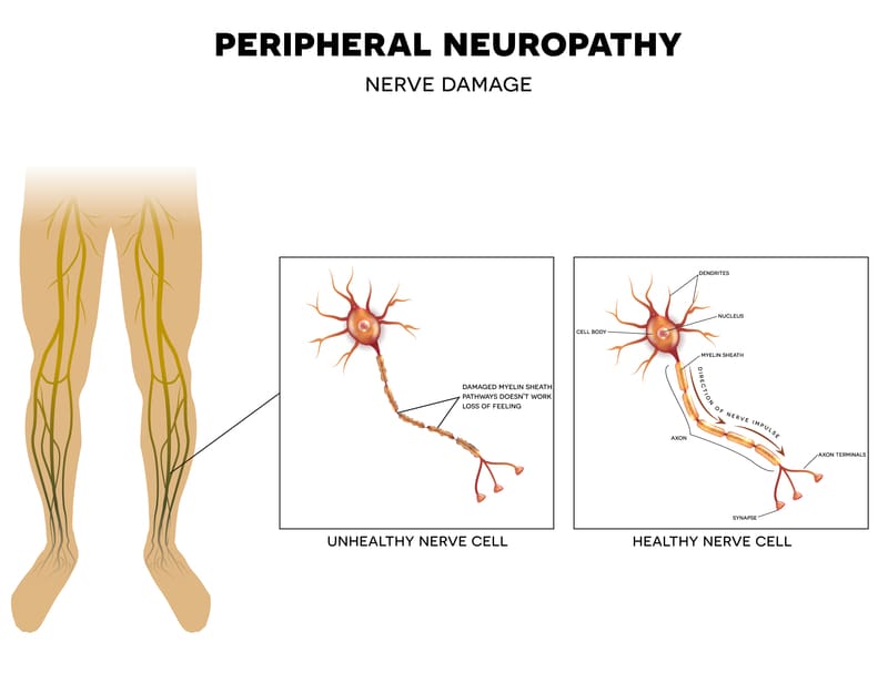 Nerve Damage In Leg 74