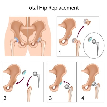 12176796 - total hip replacement surgery